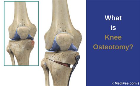 Osteotomies around the knee are not just space oddities